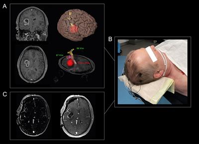 Preoperative nTMS and Intraoperative Neurophysiology - A Comparative Analysis in Patients With Motor-Eloquent Glioma